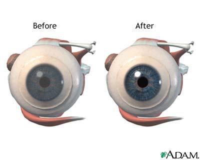fuchs dystrophy