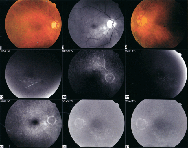 FA Laser Treatment